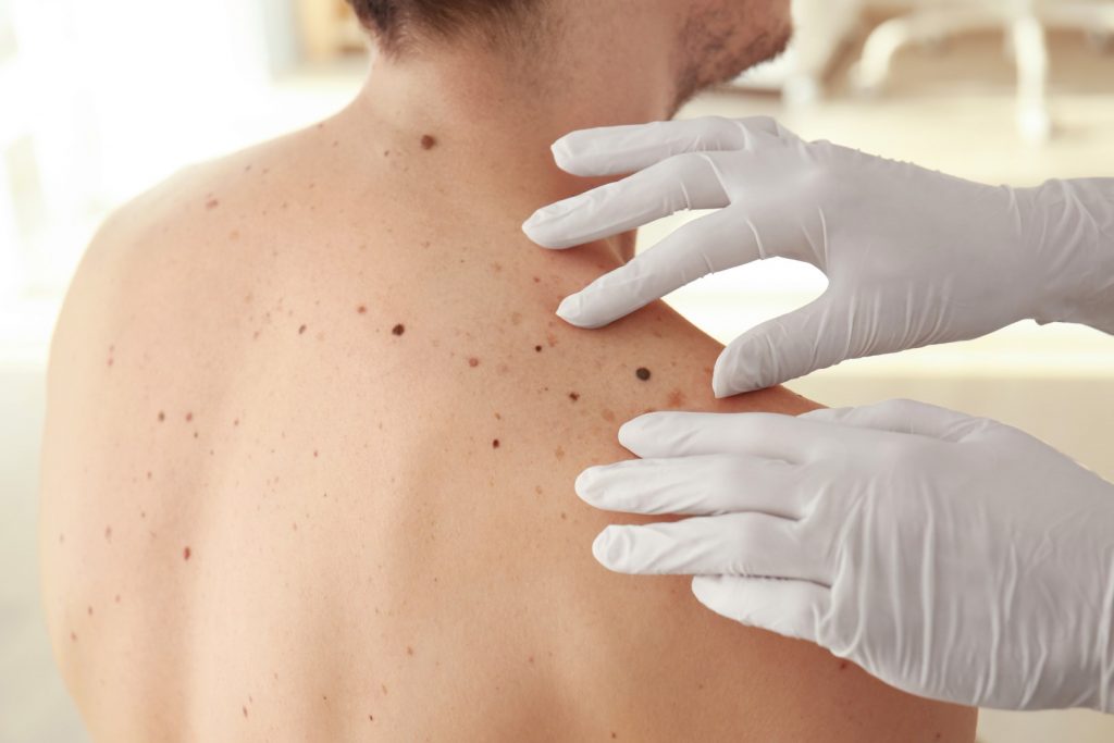 israel melanoma treatment