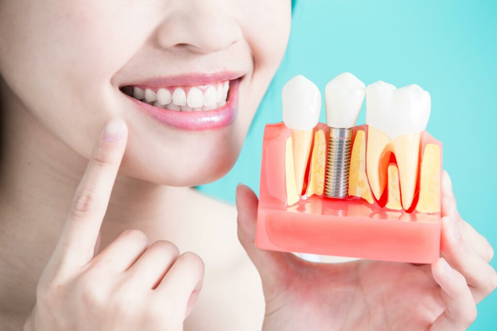 dental implants abroad
