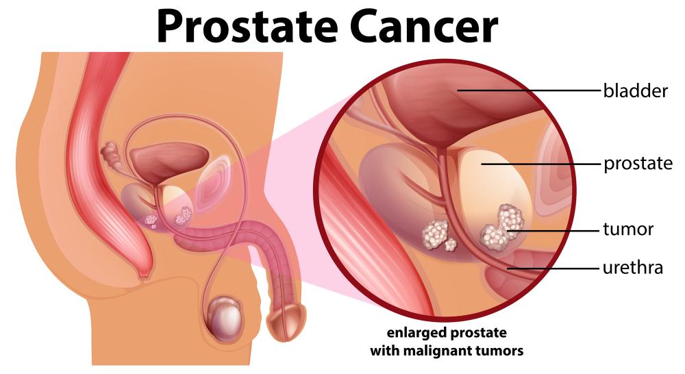 Prostate Cancer Treatment in Kano, Nigeria